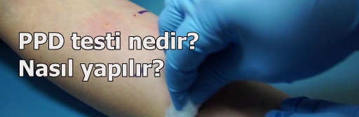 PPD testi nedir? Nasl yaplr?