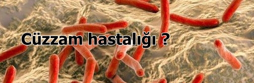 Czzam (Lepra) hastal nedir?