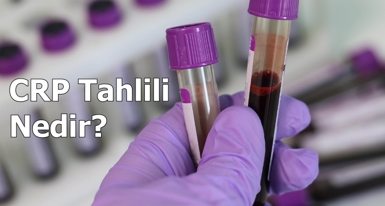 Crp Tahlili Nedir?